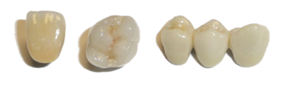 Porcelain Bonded Crown (PBC, PFM)