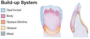 Porcelain Veneering for Porcelain Bonded Crown